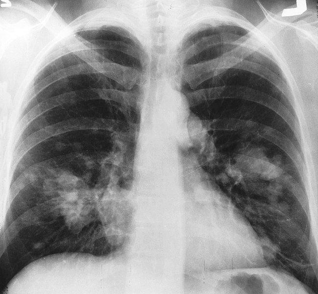 File:X-ray chest cancer.jpg