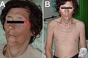 Forty-nine year-old with an adrenal crisis.