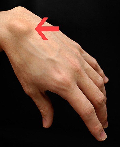 File:Ganglion-cyst.jpg