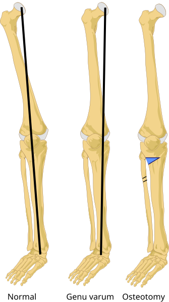 File:Osteotomy tibia en.svg