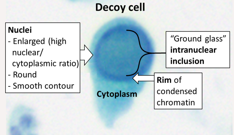 File:Decoy cell cytology.png