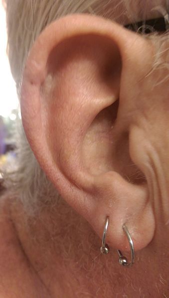 File:Mohs ear.jpg