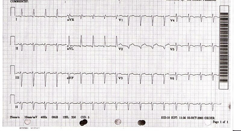 File:Takotsubo ECG.JPEG