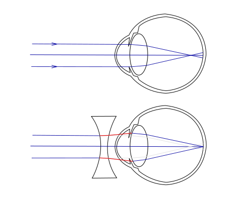 Compensating for myopia using a corrective lens.