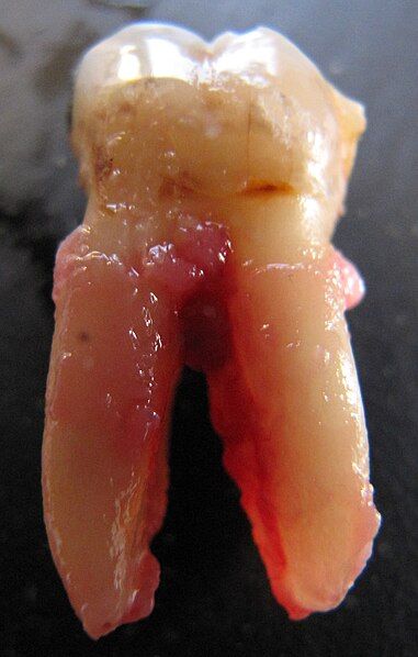 File:Pulled tooth.jpg