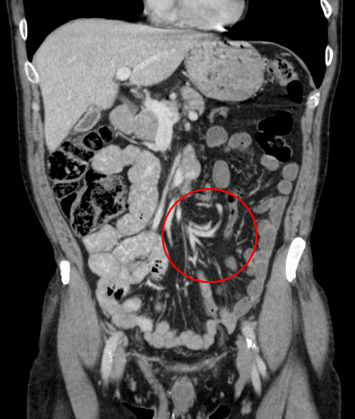 File:Volvulus.PNG