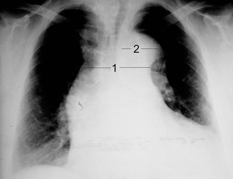 File:AoDiss ChestXRay.jpg