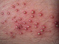 Folliculitis