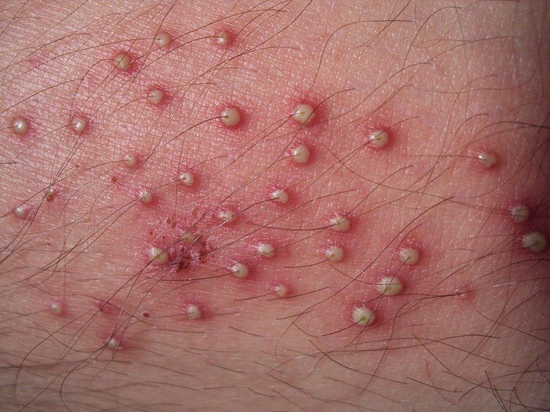 File:Folliculitis2.jpg