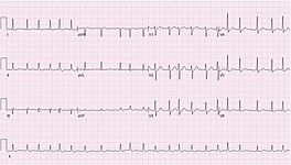 ECG of atrial fibrillation at 132 bpm