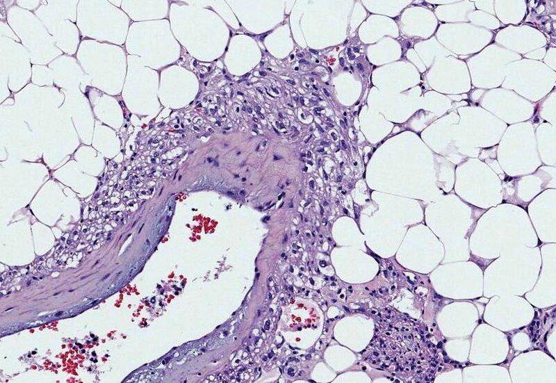 File:Angiomyolipoma.PEComa.JPG