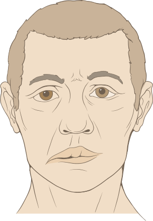 File:Bells palsy diagram.svg