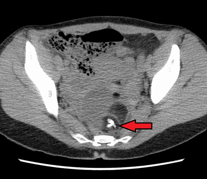 File:DermoidCyst(CT)Mark.png