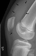 Knee effusion