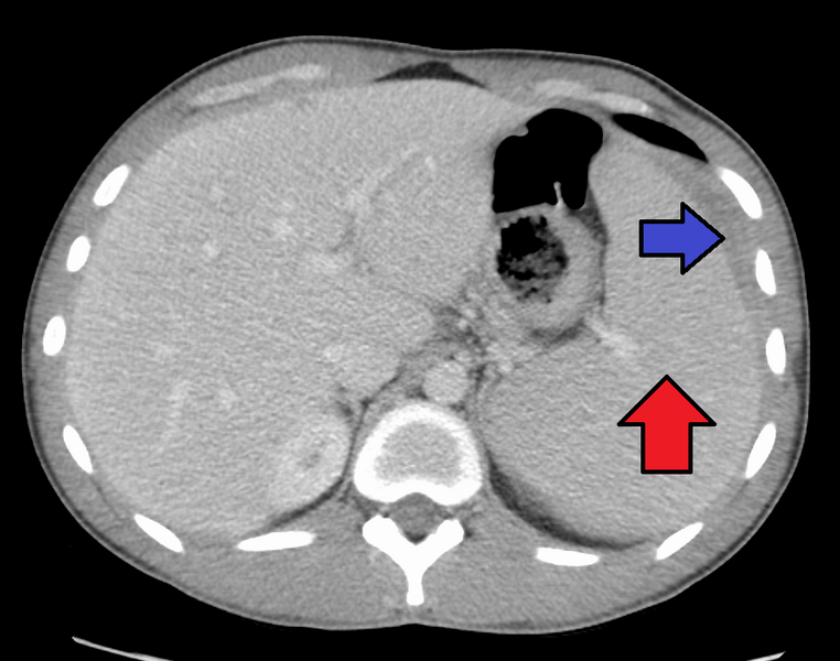 File:SplenomegalyandsubcaphematomaMarked.png