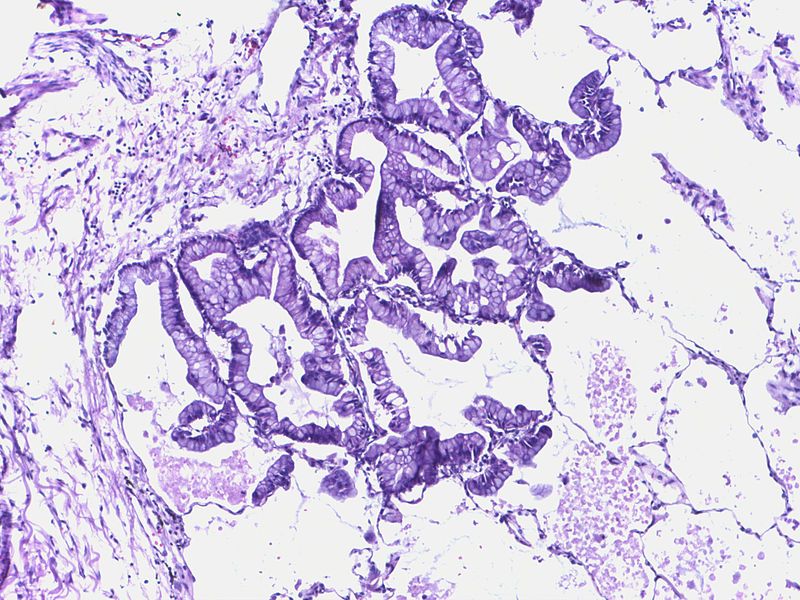 File:Bronchiolo alveolar carcinoma.jpg