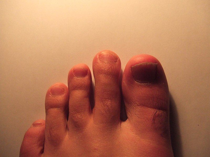 File:Mortons toe.JPG