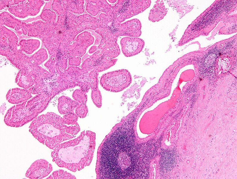 File:Papillary cystadenoma lymphomatosum2.jpg