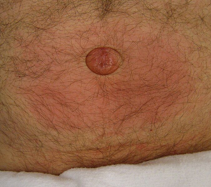 File:Umbilicalhernia.JPG