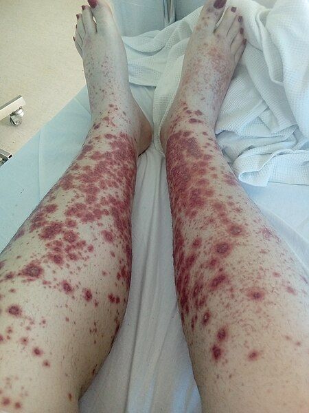 File:Vasculitis 2.jpg