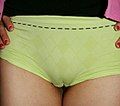 June 2009 – July 2009 A cameltoe is the outline of a woman's genitals seen through her clothing. The bulge of the mons pubis split by the cleft of venus form the shape of a camel's toe. This fashion faux pas can be a fetish and is the subject of some pornography.