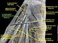 Flexor digiti minimi brevis muscle