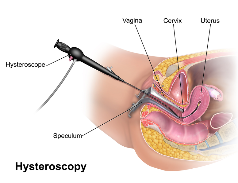 File:Hysteroscopy.png