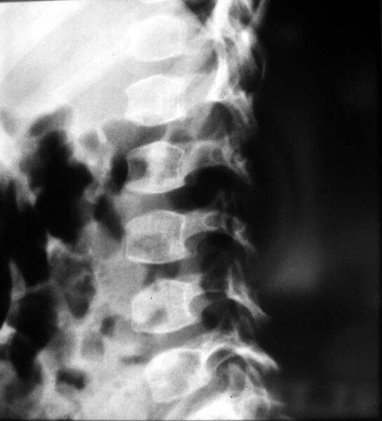 File:Spondyloepimetaphyseal-dysplasia-002.jpg