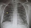 Pneumomediastinum and right sided pneumothorax post first rib fracture in a mountain biking accident.