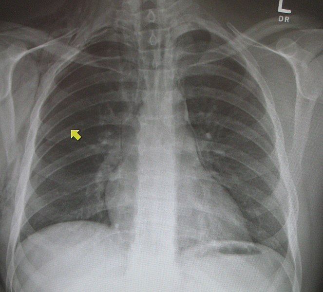 File:PneumoMediastinum2008.jpg