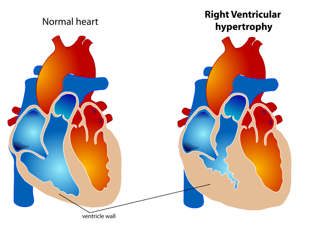 File:Right Ventricular hypertrophy.svg