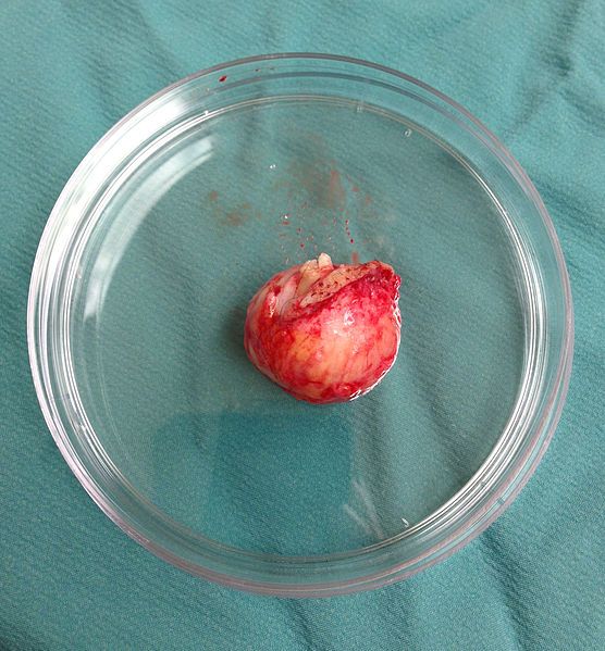 File:Sebaceous Cyst.jpg