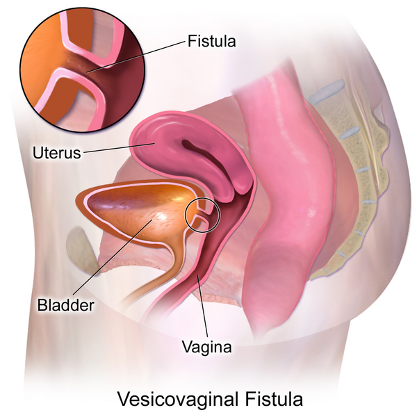 File:Vesicovaginal Fistula.png