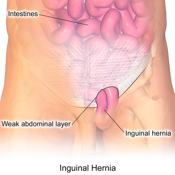 File:Blausen 0560 InguinalHernia.png