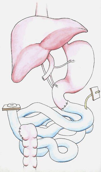 File:Intestine Transplant Diagram.jpg