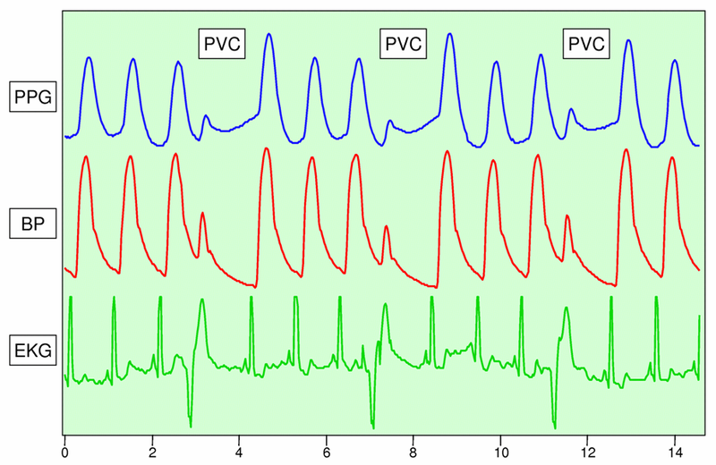 File:PVC detectionUsing PGG.png