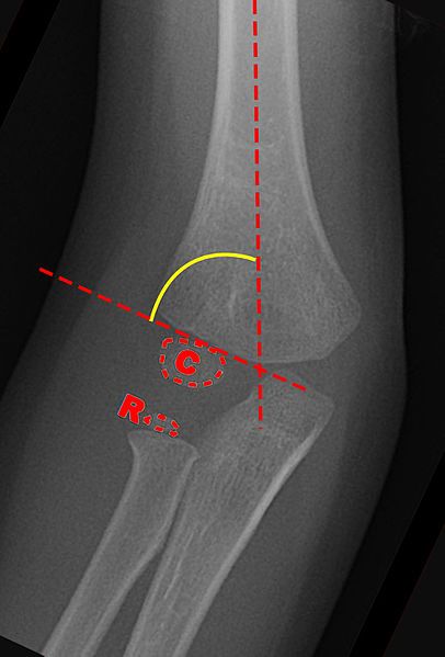 File:Baumann's Angle.jpg