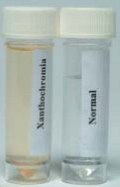 File:Xanthochromia.jpg