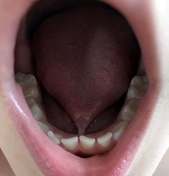 File:Ankyloglossia 2.jpg