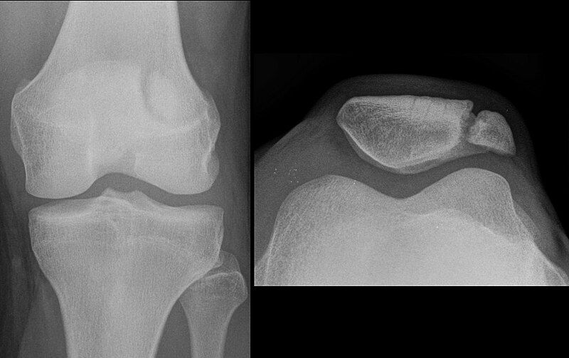 File:Patella bipartita.jpg