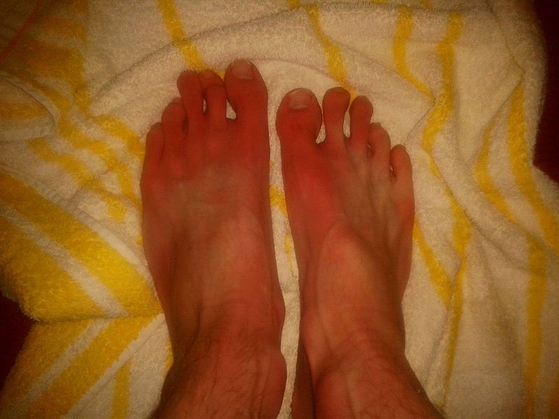 File:Erythromelalgia-symptoms.jpg