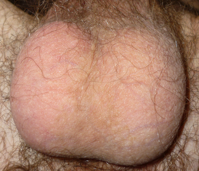 File:HairedHumanScrotum.png