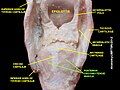 Posterior cricoarytenoid muscle