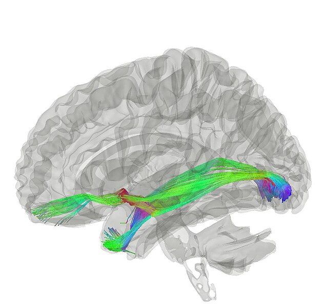 File:Anterior Commissure.jpg