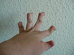 Individual with EDS showing hypermobile fingers, including the "swan-neck" malformation on the 2nd–5th digits, and a hypermobile thumb