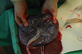 Photo of a placenta expelled after labor. Failure of complete expulsion of placenta can hinder the onset of lactation.