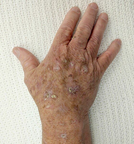 File:SolarAcanthosis.jpg