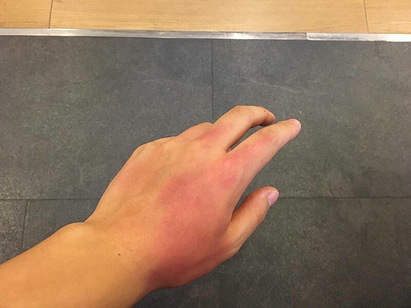 File:Chemical Burn.jpg