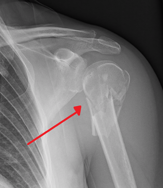 File:ProxHumeralFracture.png