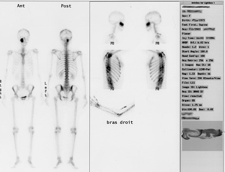 File:Scintigraphie osseuse.jpg